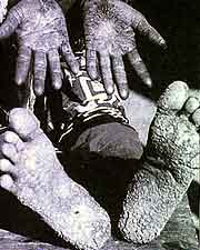 Arsenic feet